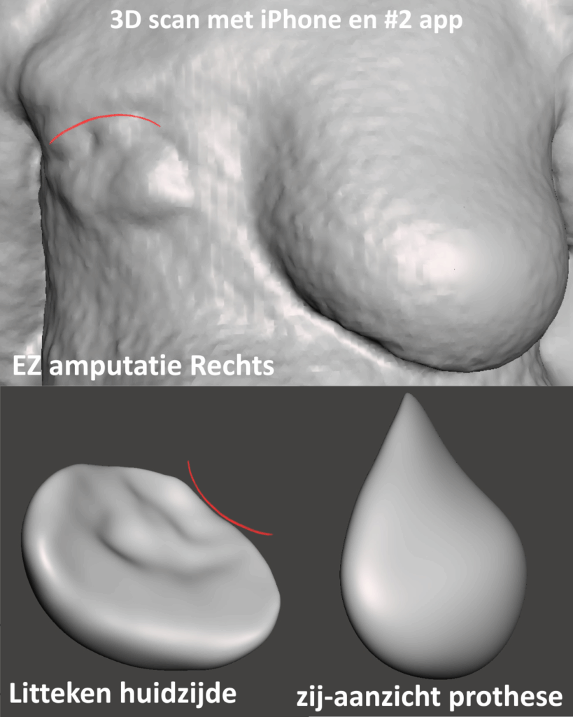 Litteken na borstamputatie