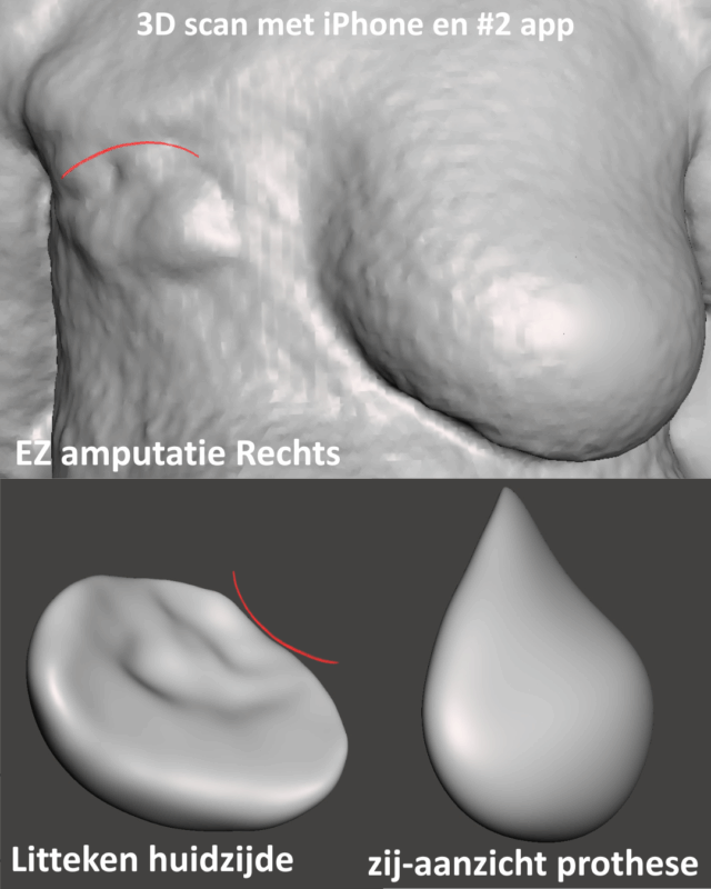 Litteken na borstamputatie
